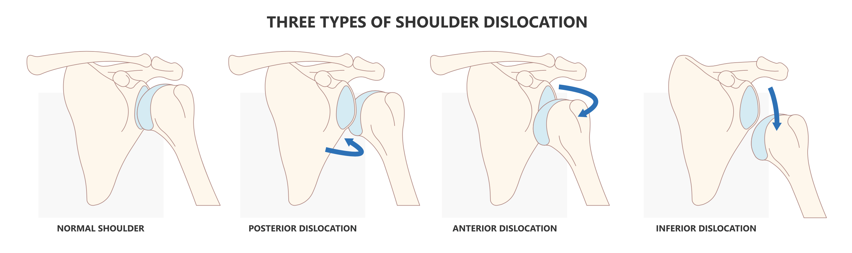 Treating Your Shoulder Dislocation and Preventing it in the Future