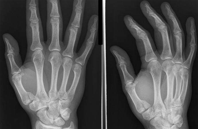 The ArmDoc Base Of Thumb Fractures