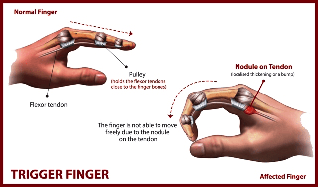 What is Trigger Finger, and What Can I Do About It?
