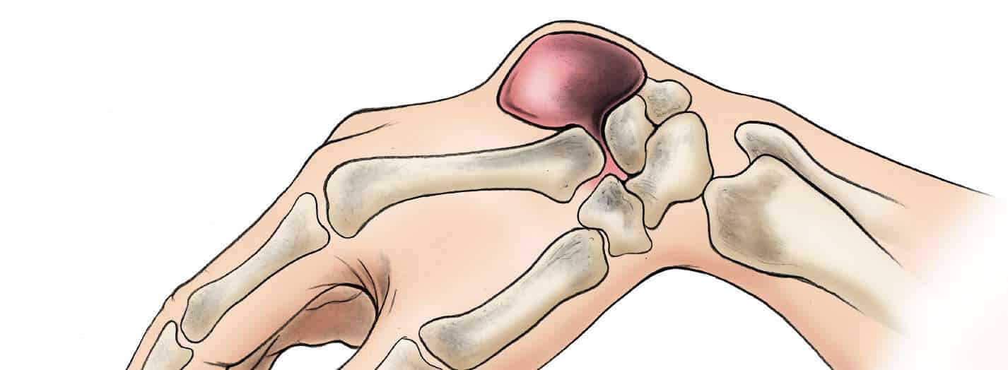 The ArmDoc Ganglion cyst