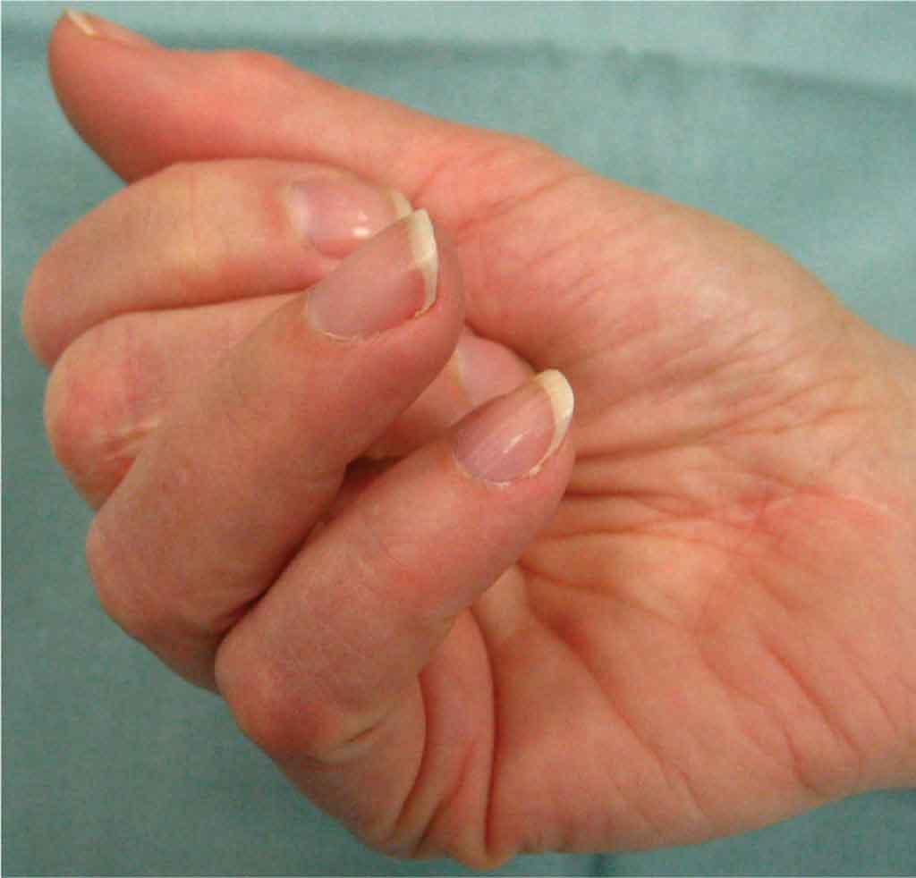 Dupuytren's Contracture: Common Questions and Answers
