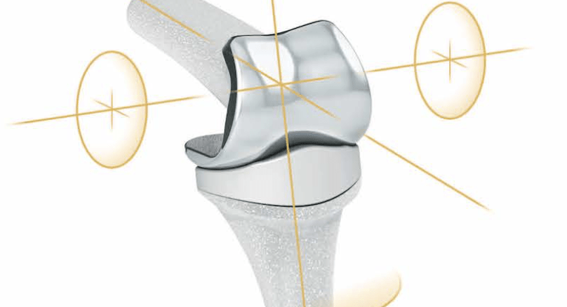 finger-joint-replacement-the-armdoc