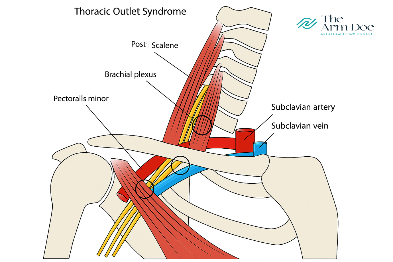 Thoracic Outlet Syndrome Uk Thoracic Outlet Syndrome Uk