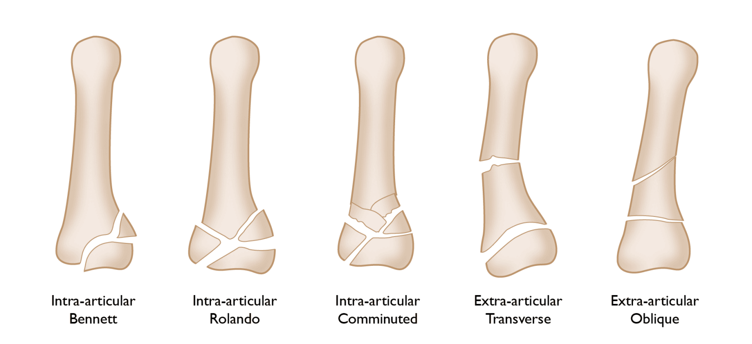 Thumb Fractures - The ArmDoc