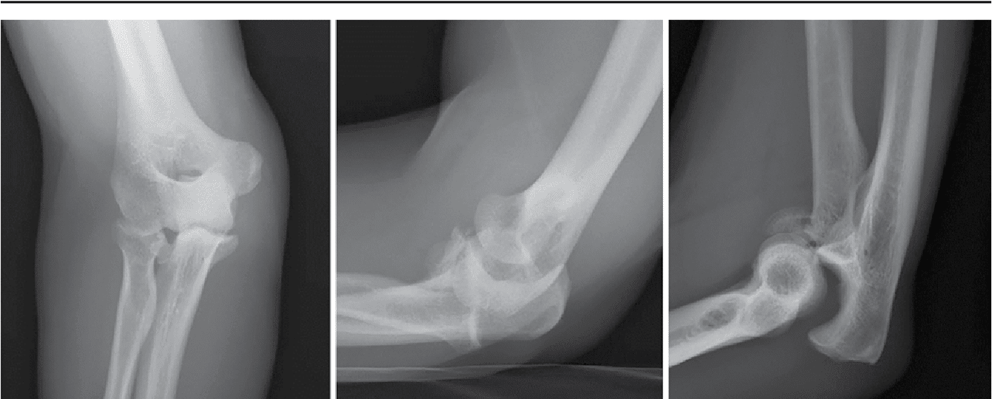 Complex Elbow Injuries The ArmDoc - Terrible Triad Injury of the Elbow