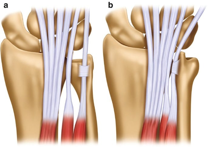 The ArmDoc - Extensor Carpi Ulnaris Subluxation