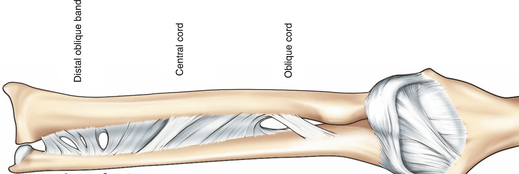 The ArmDoc Reconstruction for Interosseous Ligament Disruption
